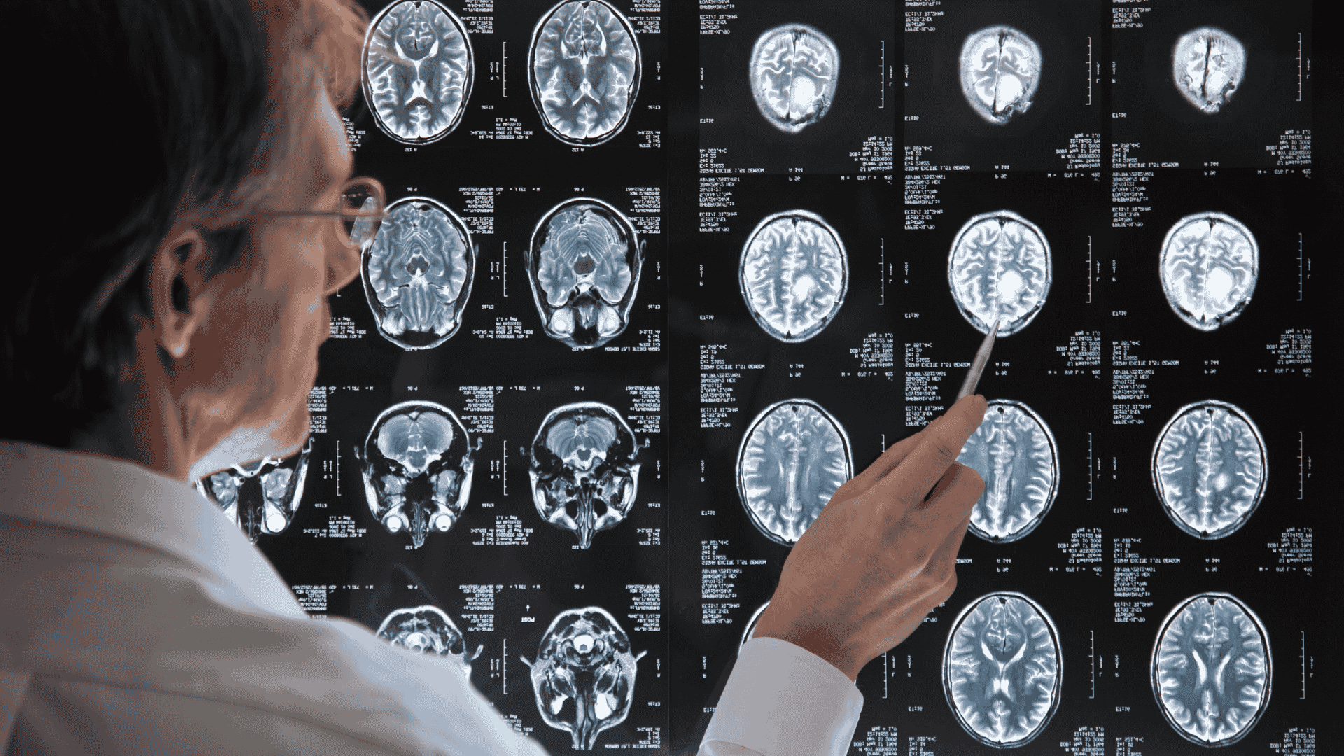 Person granskar hjärnscanningar på ljusbräda med en pekpinne.