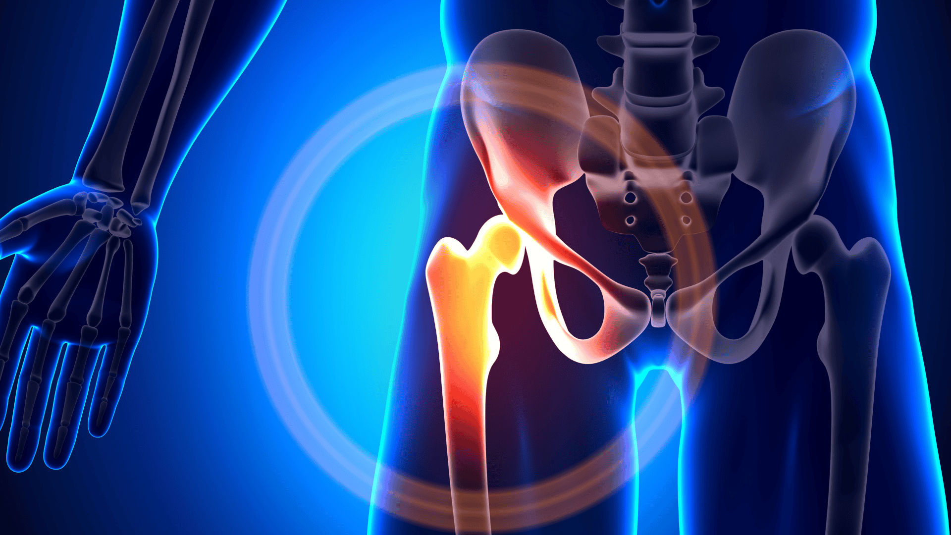 Röntgenbild av bäcken med fokus på en höftled som lyser upp i rött, indikerar kanske inflammation eller skada.