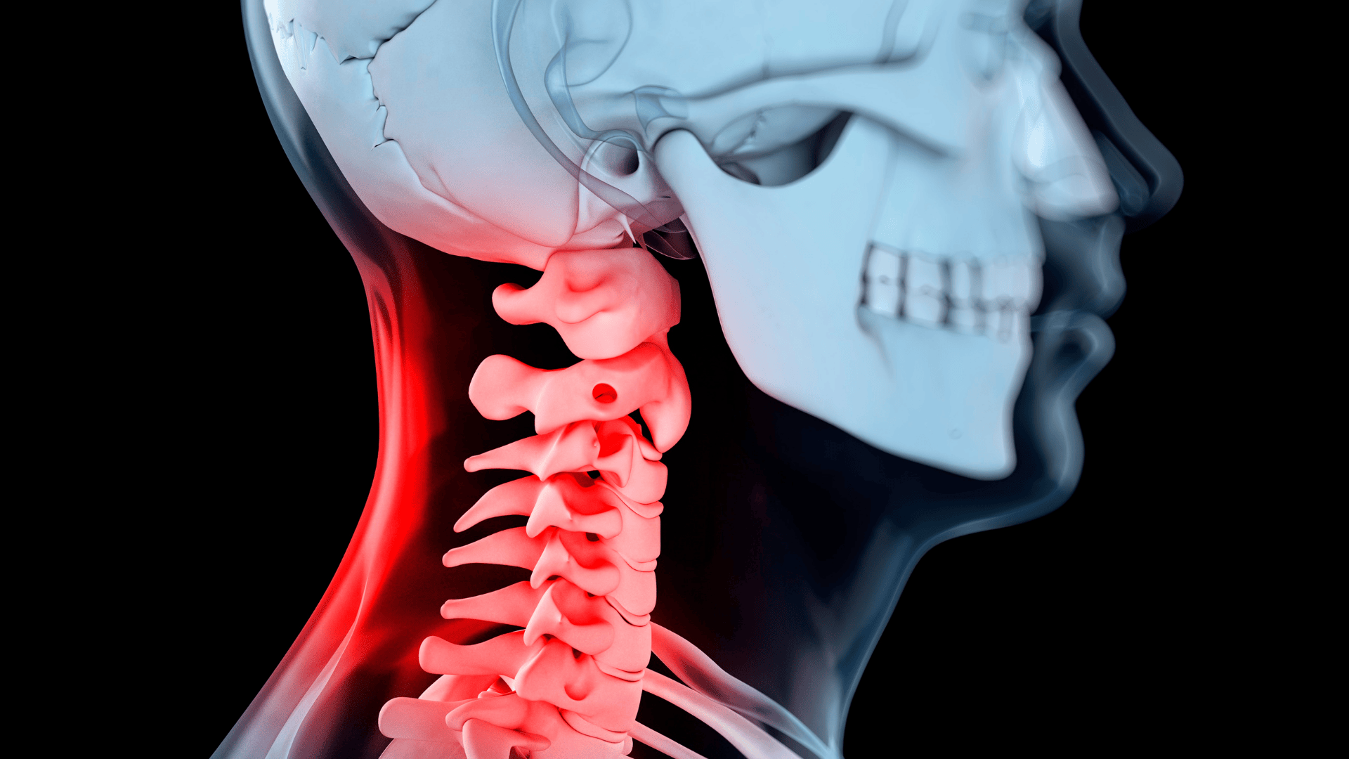 Röntgenbild av en människas hals och ryggrad med röda områden som markerar smärta eller inflammation.